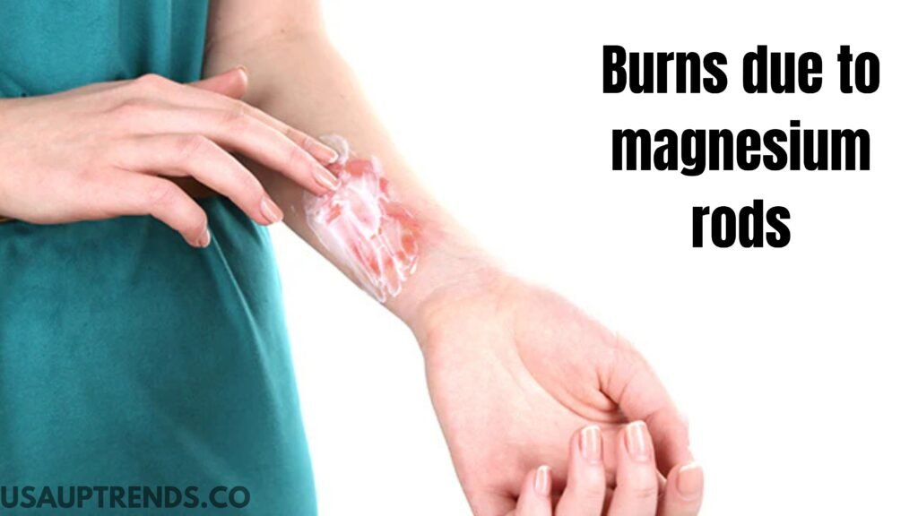 Burns due to magnesium welding rods