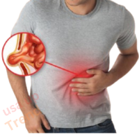 Hernia
A hernia is a way of saying that an organ, such as part of the intestine, pushes outward,