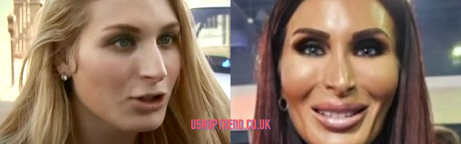 Laura Loomer’s plastic surgery