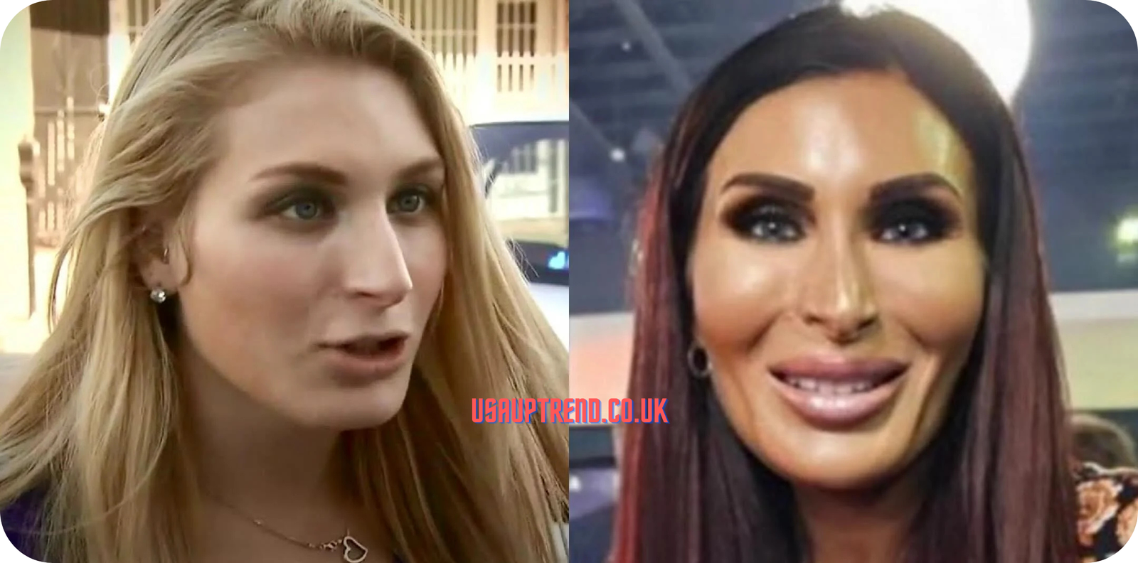 Laura Loomer’s plastic surgery